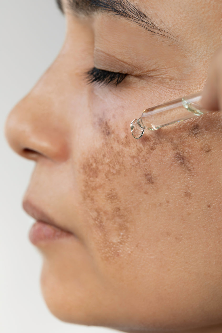 Gros plan d'un visage féminin de côté avec des zones craquelées sur la joue, sur lesquelles du sérum est appliqué