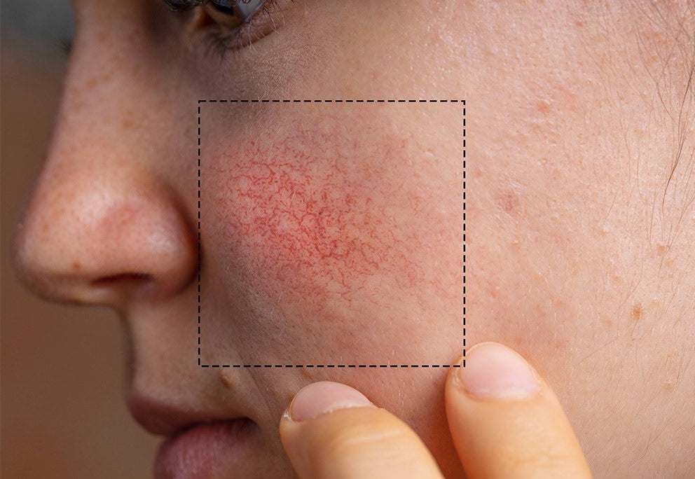 Visage avec zone de rosacée marquée sur la joue