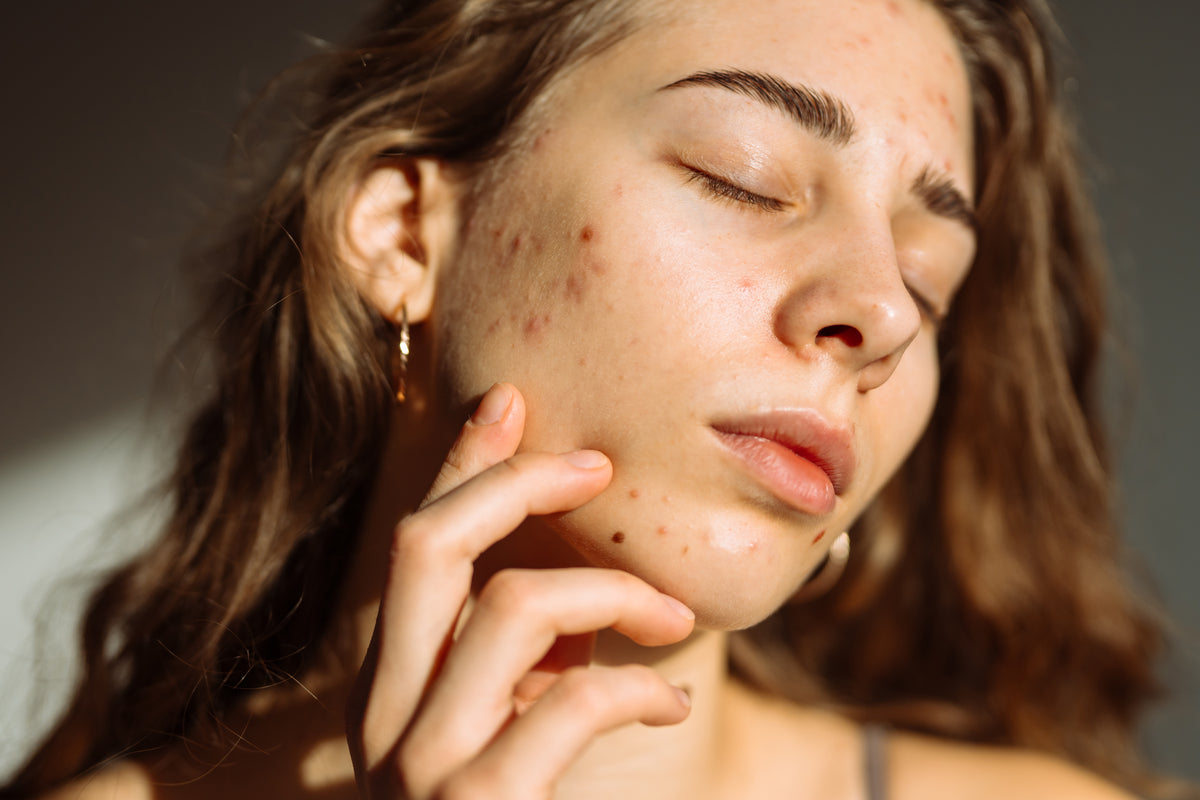 Primo piano del viso di una giovane donna con zone secche e brufoli sulla guancia