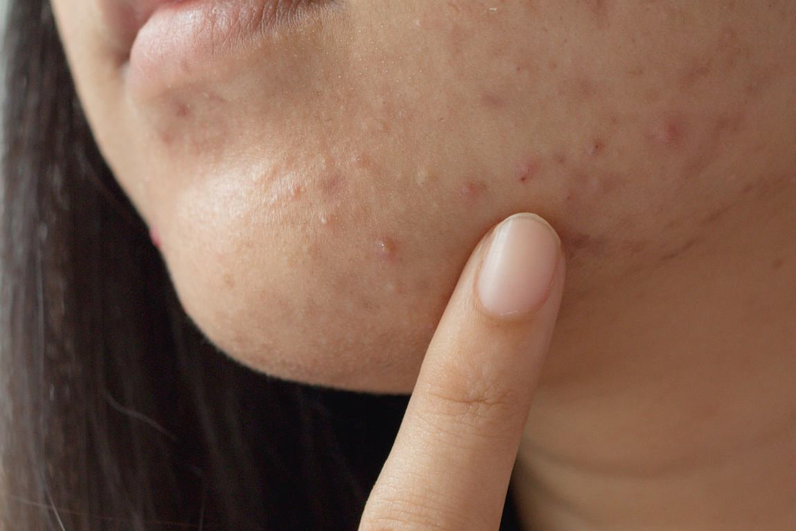 Aufnahme eines Kinns mit Pickeln